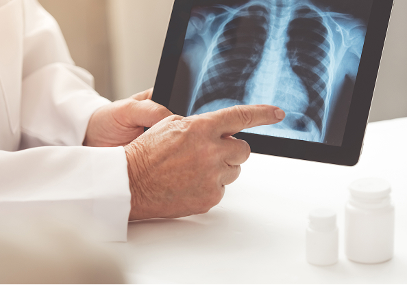 Exame de raio X de pulmão sendo analisado por médico